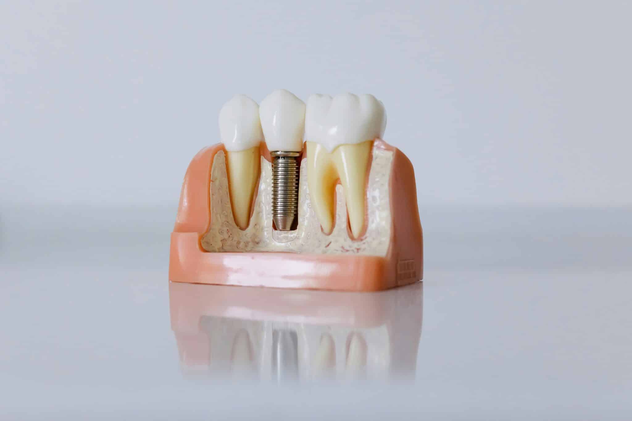 Como Anunciar Implantes Dentários